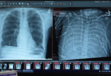 இரு நுரையீரல்களும் இல்லாமல் 48 மணி நேரம் வாழ்ந்த மனிதன்